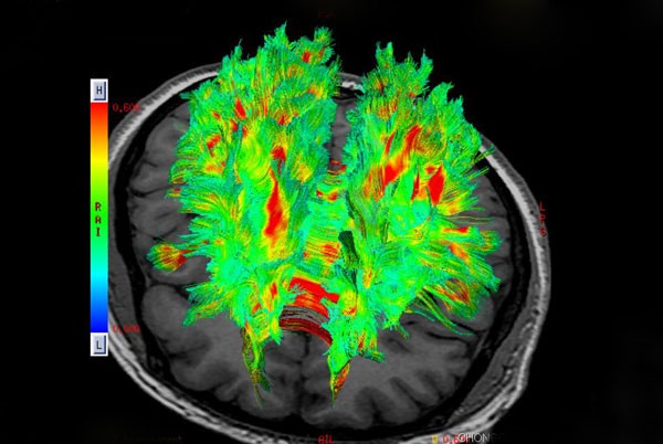 頭部核磁3D成像