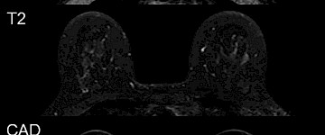 最新研究可減少MRI乳腺癌篩查中的假陽性